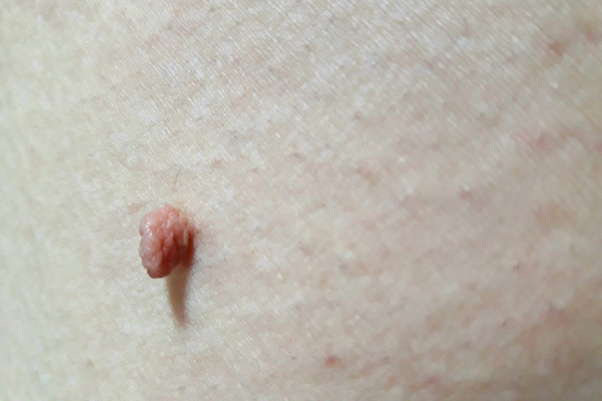 Removing skin tags in Dubai Removing skin tags in Dubai